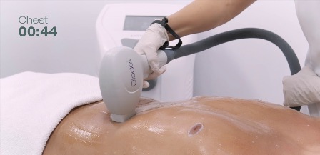 bezbolesna epilacja laserowa bydgoszcz