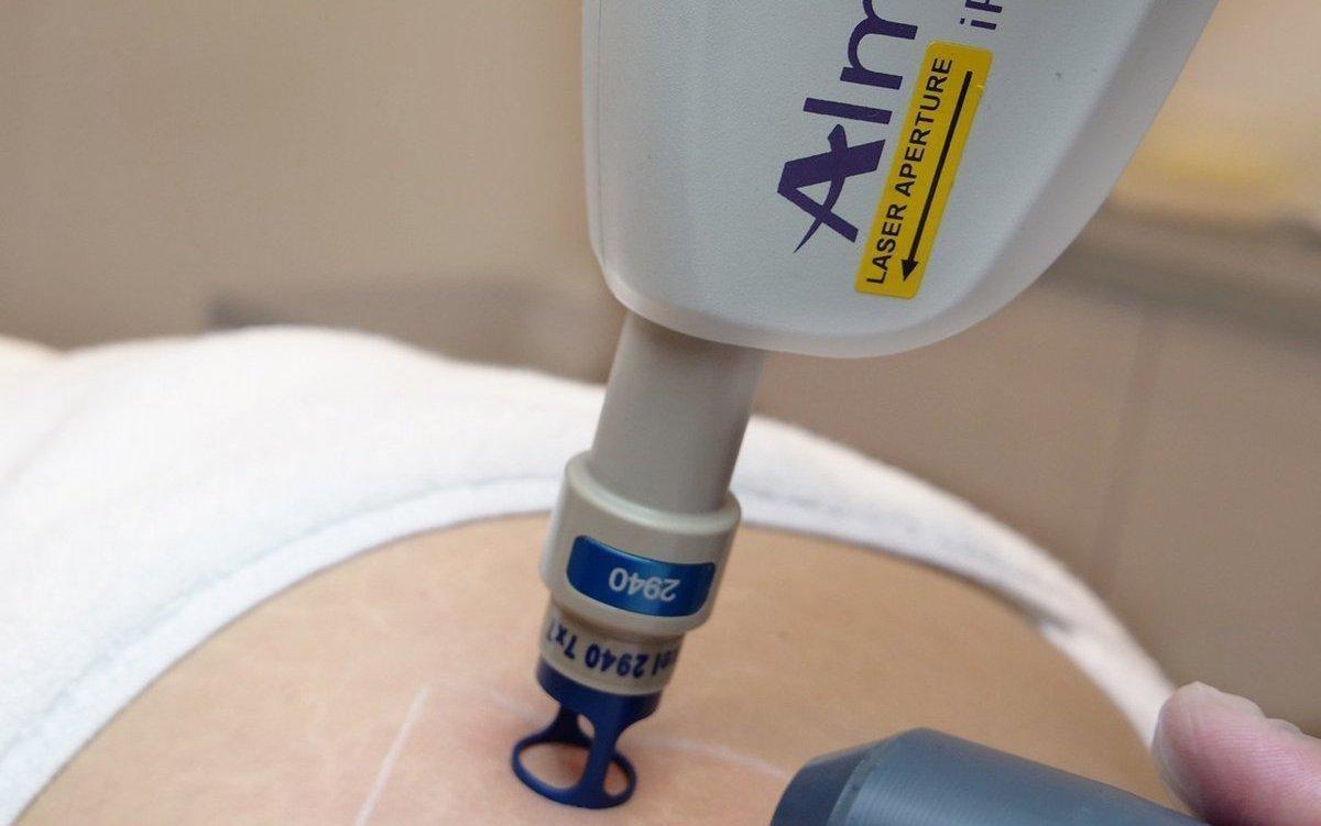 laserowe usuwanie rozstepow