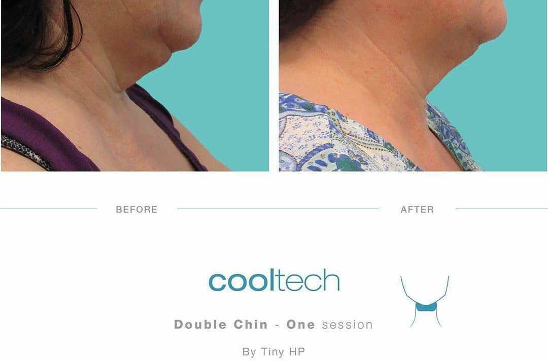 podwójny podbródek Bydgoszcz